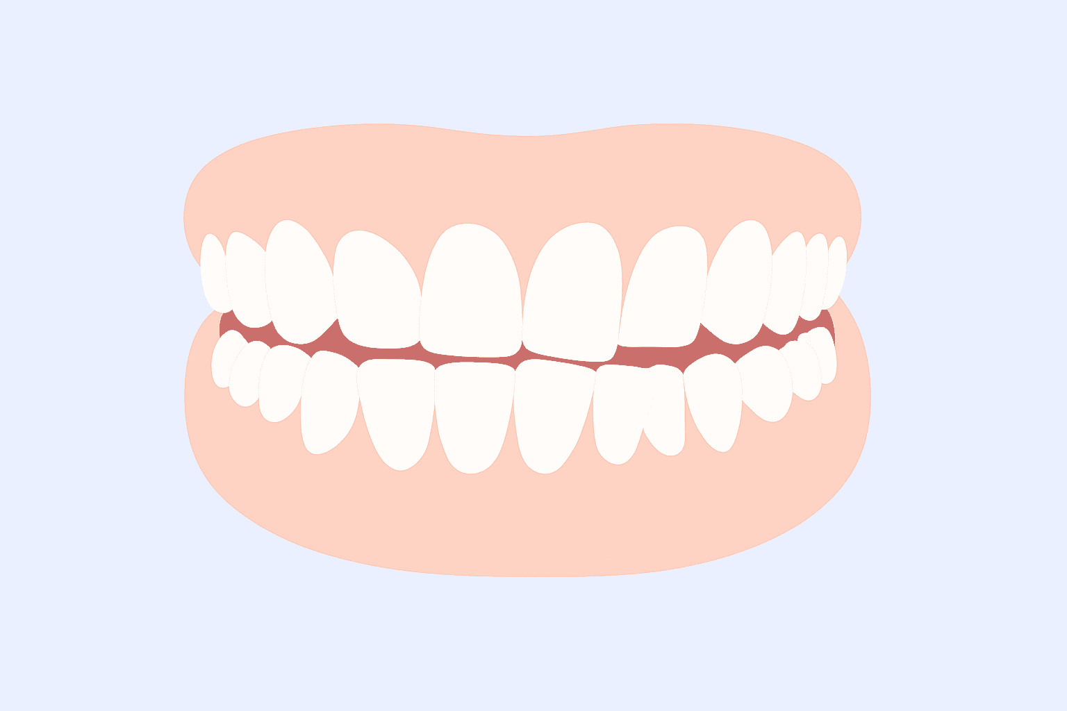 Crooked-teeth
