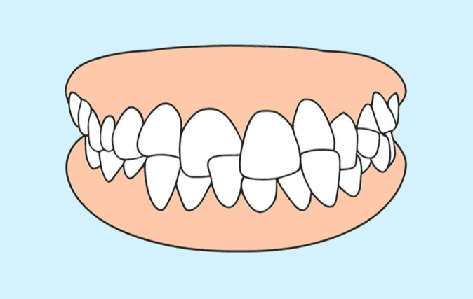 Cross-bite