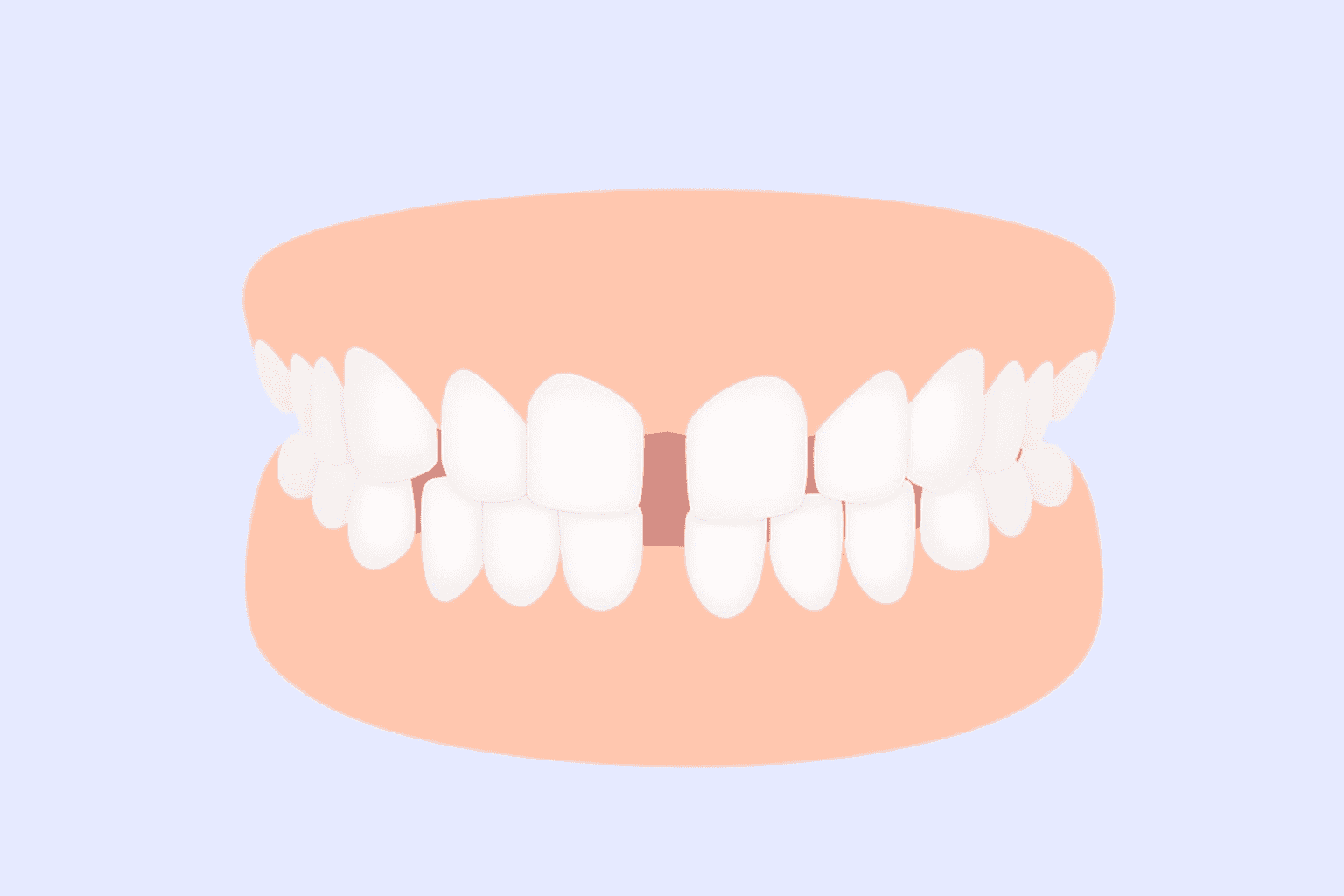 Teeth gap